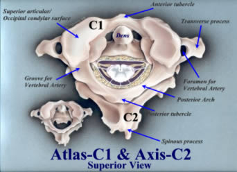 Atlas-C1 and Axis-C2 Superior viewsubluxation 