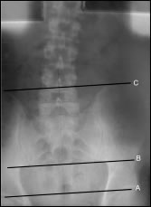X-ray: Scoliosis