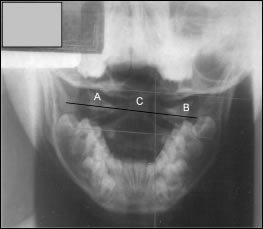 Nasium (open mouth) X-ray