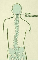 Atlas Subluxation