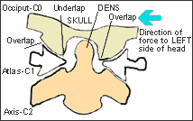 Figure 2: Upper Cervical Spine - Skull to atlas subluxation 