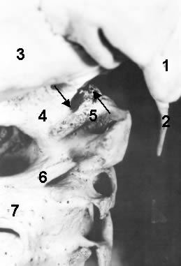 Figure 4: A close look at the subluxation!