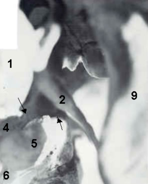 Figure 5: An even closer look at the subluxation!