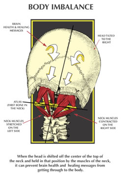 Figure 6: The Effects of the Atlas Subluxation