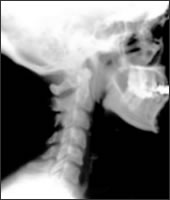 X-ray sagittal or side view