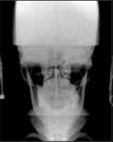 X-ray Nasium view