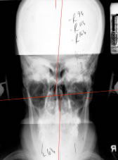 Pre-adjustment X-ray