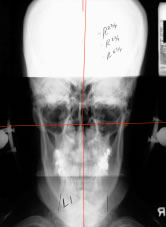 Post adjustment x-ray