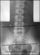 X-ray: Scoliosis