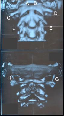 3 Dimensional Helical CT Scanner