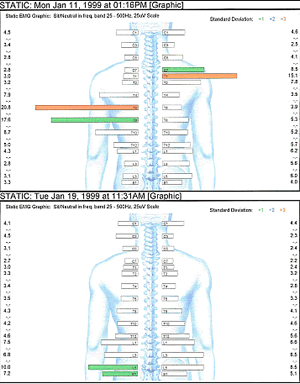 Electromyography (EMG)